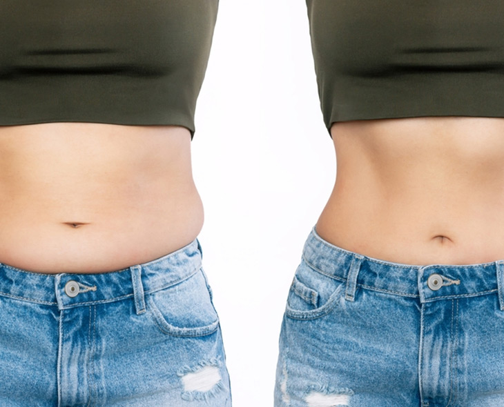 liposuction nasıl yapılır